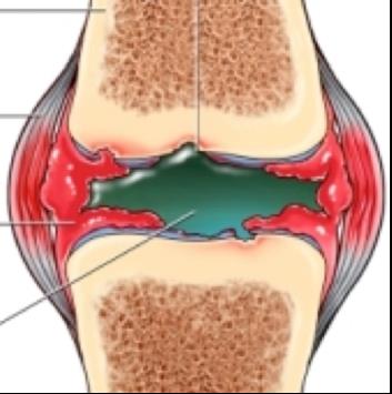 deformáló osteoarthrosis arthrosis kezelés a csípőízületek izmainak fájdalmainak okai