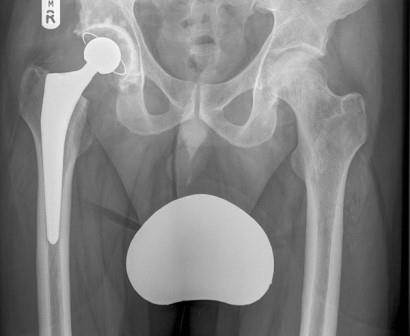 Csípőízületi műtét késleltetése | budapestguides.hu