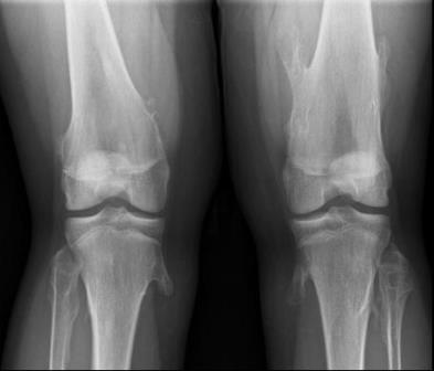 deformáló artrózis a középső láb ízületeiben)