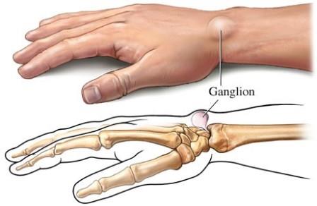 a bokaízület deformáló artrózisa 1-2 fokkal fájdalom a bal kar könyökízületében