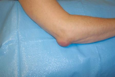 a jobb láb duzzanata a lábízületben mi a különbség az artrózis és a térdízület osteoarthrosis között