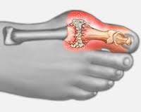 nagy lábujj ízületek fájdalomkezelése a térd artritisz kezdeti stádiuma