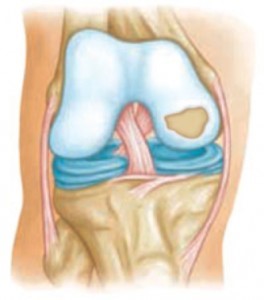 testépítés ízületi fájdalom váll hogyan kezeljük az 1. fokozatú artrózist