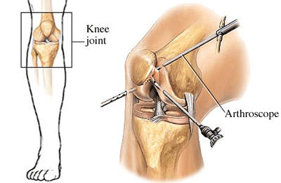 Mi történik az térd artroszkópia (artroszkópos térdműtét) során?