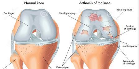 artrózis jelenléte a középső láb ízületeiben