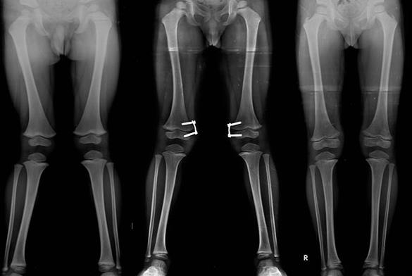 deformáló artrózis a középső láb ízületeiben)